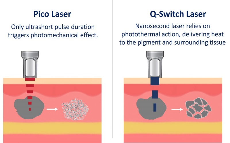 Pigmentationv Treatment Pico Laser vs Tradition Q switch Laser.jpg